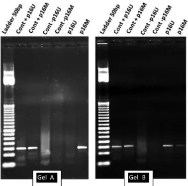 Fig. 1 - Gel A shows a methylated sample (band on p16M), Gel B shows a methylated sample  with mixed forms (P16U + and p16M +)