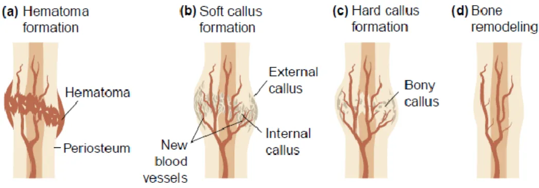 Figure 4.  The stages of fracture repair. (a) Hematoma  formation: following injury, disruption of blood  vessels leads to formation of a hematoma; (b) Soft callus formation: this stage involves the formation of  new blood vessels from pre-existing ones (a