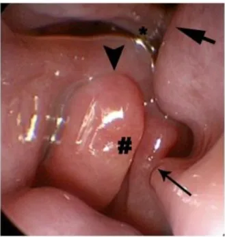 Figure 14: Nasal cavity with extensive mucosal contact. There is contact between the plica recta and  septum (thick arrow), between the lamella of the concha nasalis ventralis (CNV) and the septum (thin  arrow), between the lamellae of the CNV (#), between