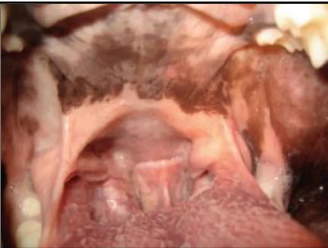 Figure  15:  Soft  palate  that  extends  beyond  the  tip  of  the  epiglottis  and  tonsillar  crypts  (Trappler  &amp; 