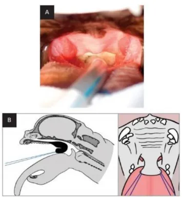 Figure 19: Folded flap palatoplasty technique – part 3. Figure adapted from Findji &amp; Dupré (2013)