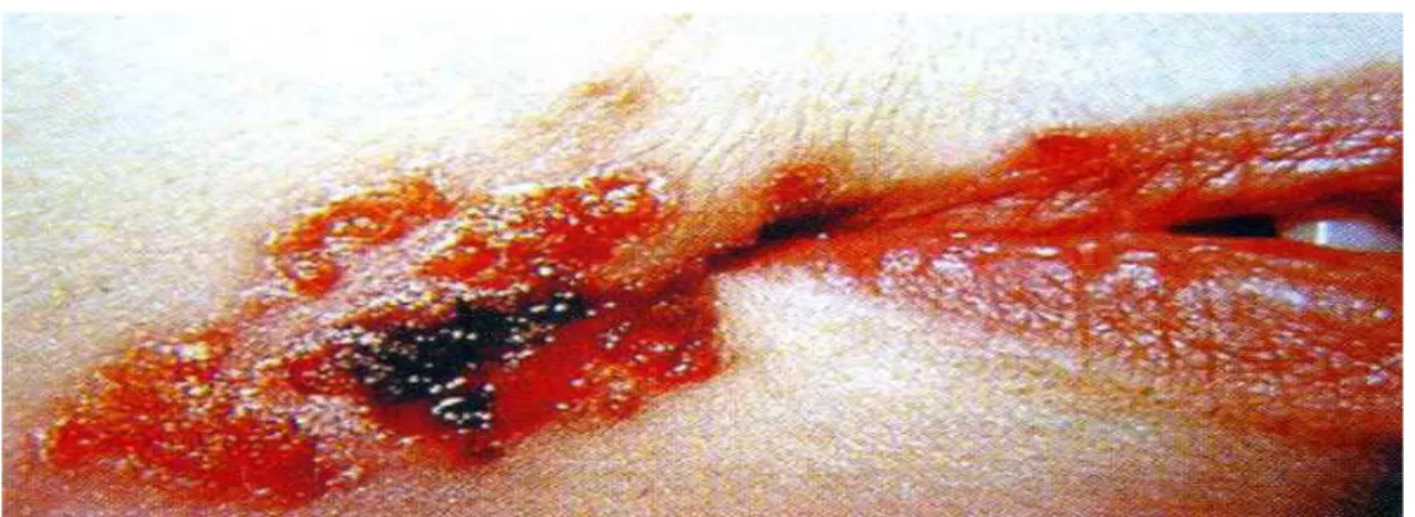 FIGURA 1: Impetigo: lesão cutânea localizada.  Fonte: Santos-Filho (2003). 