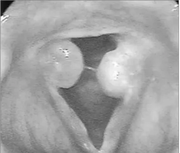 Figure 1. Granulomas in both vocal apophyses