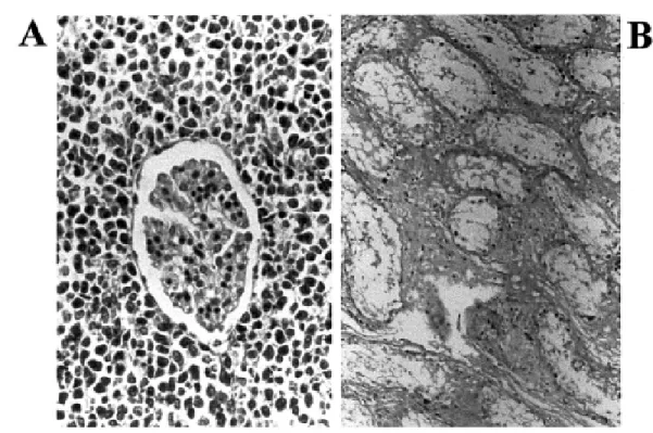 Fig. 1 - Histopathological lesions in benznidazole treated rabbit. A: Malignant non-Hodgkin’s lymphoma invading the kidney