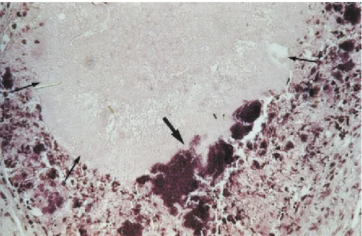 Fig. 3 - A dead S. mansoni worm (thin arrows) in the liver of a mouse surrounded by colonies of Staphylococcus aureus (thick arrow).