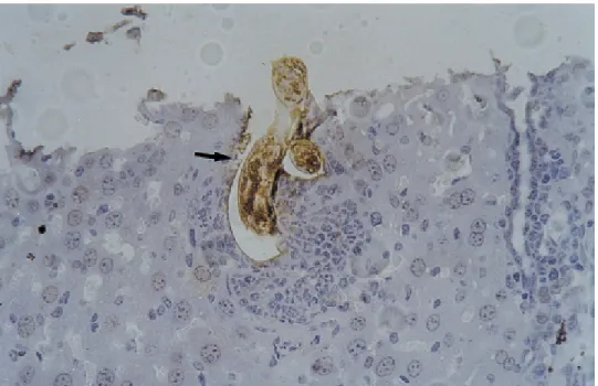 Fig. 4 - Computerized tomography showing an abscess (arrow) in the left gluteous muscle of a patient with tropical pyomyositis.
