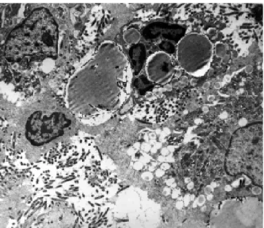 Fig. 2 - Electron microscopy of the jejunal mucosa from patient with Whipple’s disease before treatment