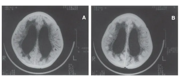 Fig. 1 - Axial CT scan from case 2. (A) Unenhanced CT scan showing hydrocephalus and hypodensity of the cerebral white matter
