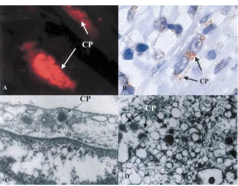 Fig. 2 - Demonstration of Chlamydia pneumoniae (CP) in adventitia cells of vulnerable coronary atheroma segment through many different techniques