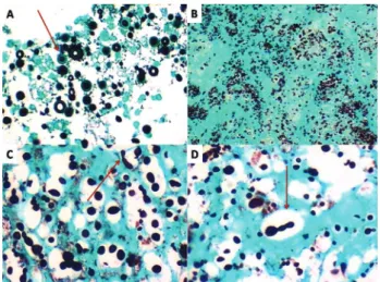 Fig. 1 - A, Left axillary tumor biopsy with paucireactive cryptococcosis. Numerous yeast-like  organisms are surrounded by clear halos representing gelatinous capsules stained with HE  (case 4) (x 10)