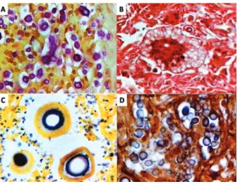 Fig. 3 - A, Cervical lymph node biopsy. Pseudohyphae demonstrating branching and numerous  conventional yeast cells with the magenta capsules stained by Mayer’s mucicarmine stain (case  6) (x 10)