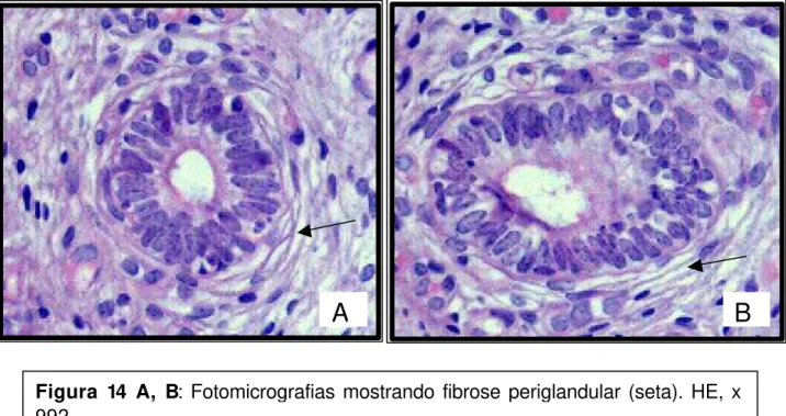 Figura 15 A, B: Fotomicrografias mostrando infiltrados inflamatórios (INF) no 