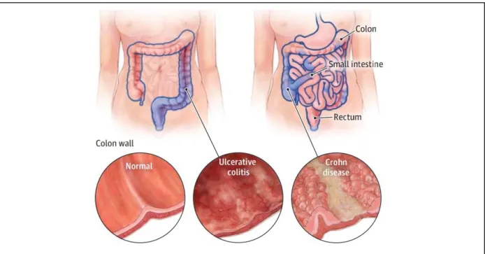 Figure  1.2  –   Localization  and  extension  of  chronic  inflammation  induced  by  ulcerative  colitis  and  C rohn’s  disease