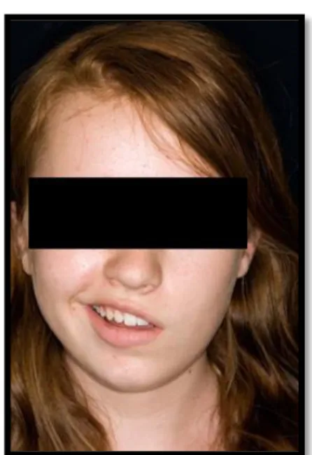 Figura  10  –  Imagem  ilustrativa  de Paralisia facial (Advancecare,  2016). 
