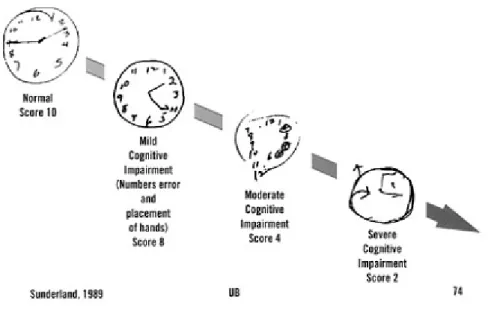 Fig. 4: exemplos de desenhos para o horário estabelecido pelo examinador: 02:45.  O teste do relógio é extremamente rápido (pode ser aplicado em 2 minutos) e traduz  o padrão de funcionamento frontal e têmporo-parietal