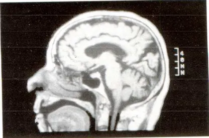 Fig. 5: Ressonância Magnética em corte sagital mostrando importante atrofia cortical  e difusa da fissura parieto-occipital