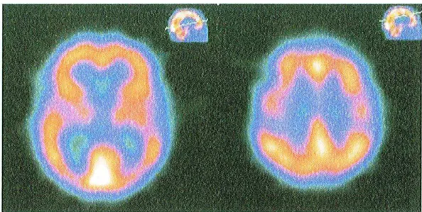 Fig. 7: Imagem SPECT de um paciente com DA, mostrando hiperfusão nos lobos  temporais e parietais