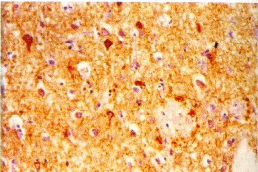 Fig. 8: Presença de emaranhados neurofibrilares e placas senis não coradas na  região central composta por  β amilóide