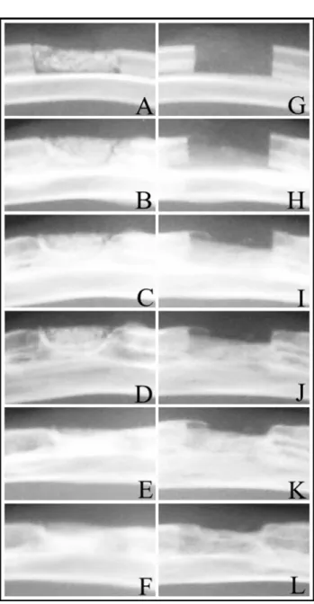 FIGURE 1 - Typical radiographic appearance of the defects of Group A, immediately after surgery (A) 30 (B), 60 (C), 90 (D), 120 (E), and 150 (F) days postoperatively; and of Group B, immediately after surgery (G), 30 (H), 60 (I), 90 (J), 120 (K), and 150 (