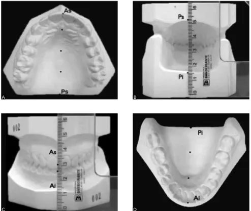 Table 1 shows the distribution of the individuals  comprising the sample, considering the side of the  molar mesially positioned and the dental arch