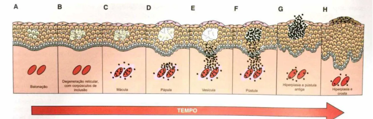 FIGURA  1-  Esquema  ilustrativo  de  uma  lesão  por  Poxvírus  no  decorrer  do  tempo