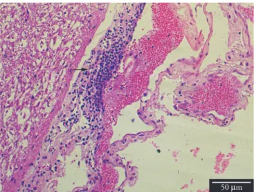 Figure 3. Congested meninges associated with severe and diffuse  mononuclear inflammatory infiltration