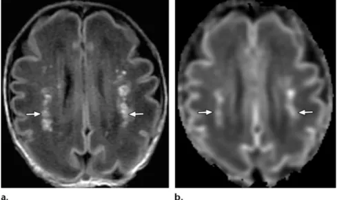 Figure 17.  MR imaging appearance of acute periventricular leukomalacia. Axial  T1-weighted (a) and diffusion-weighted (b) images obtained in a neonate at  ap-proximately 30 gestational weeks show multiple bilateral foci of high signal  inten-sity due to T