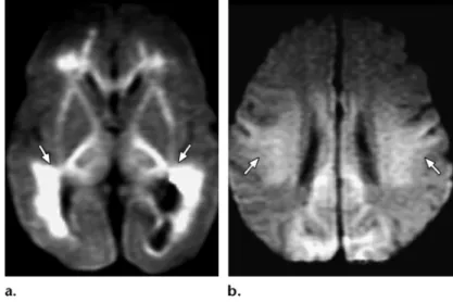 Figure 2.  Neonatal hypoglyce- hypoglyce-mia. Axial diffusion-weighted MR  image demonstrates restricted  water diffusion in both occipital  lobes (arrows) and in the  sple-nium of the corpus callosum.