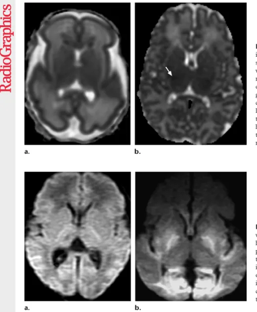 Figure 6.  (a) ADC map obtained  in a neonate at 26 weeks of gestation  shows moderately decreased cortical  water diffusion and increased white  matter water diffusion