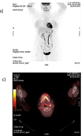 Figura  10 .  Imagens  de  18F-FDG  PET/CT  do  indivíduo  II.4.  Nota-se  hipermetabolismo  de  linfonodos cervicais em área de esvaziamento  cervical  recente  por  paraganglioma  de  corpo  carotídeo  bilateral,  sugerindo  metástases  locais (vide text