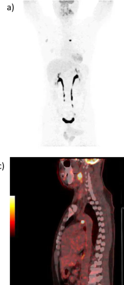 Figura  11.  Imagens  de  18 F-FDG  PET/CT  do  indivíduo  II.5,  probando.  As  imagens  evidenciam  áreas  hipermetabólicas  em  região  cervical  (figura  11b)  e  mediastinal  (figura  11c)  sugestivas  de  comprometimento  neoplásico  (paragangliomas 