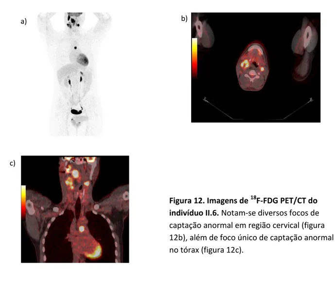 Figura 12. Imagens de  18 F-FDG PET/CT do  indivíduo II.6. Notam-se diversos focos de  captação anormal em região cervical (figura  12b), além de foco único de captação anormal  no tórax (figura 12c).