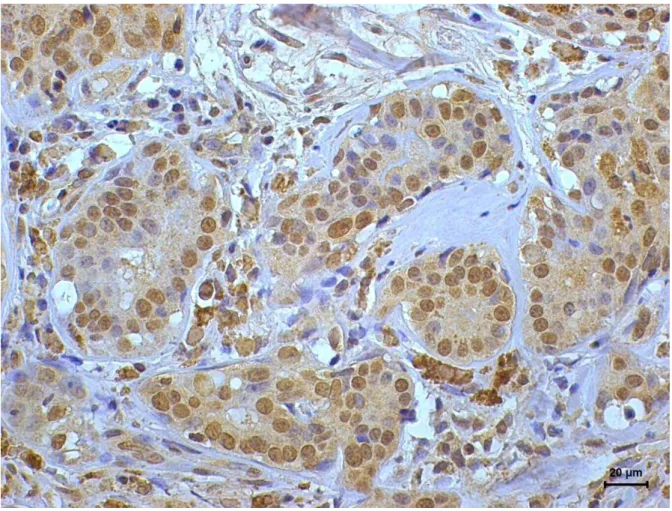 Figure 1.  Immunoexpression of estrogen- α receptor in breast carcinoma from a female dog