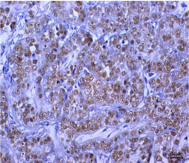 Figure 2. Immunoexpression of p63 in female dog breast carcinoma. Positive nuclear  staining in neoplastic cells
