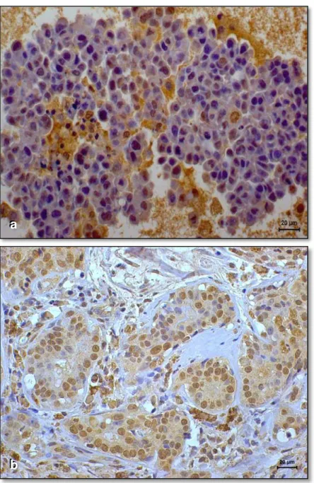 Figura  1.    Imunoexpressão  de  receptor  de  estrógeno- α  em  carcinoma  de  mama  de  cadela