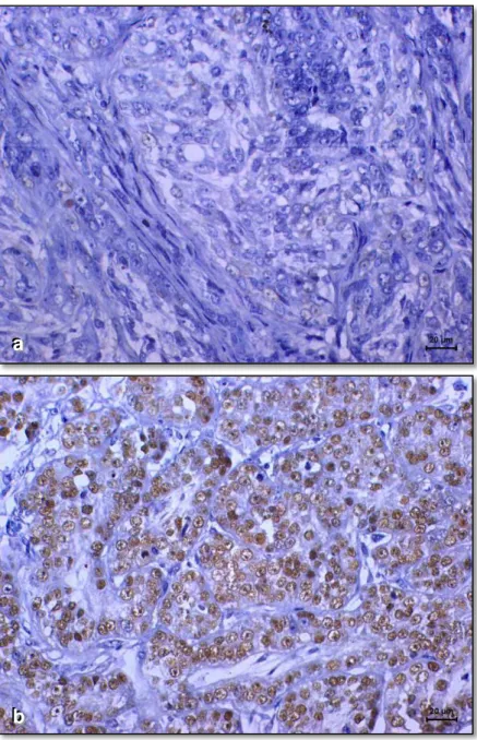 Figura  2.  Imunoexpressão  de  p63  em  carcinomas  de  mama  de  cadelas.  a)  Ausência  de  marcação  nas  células  neoplásicas  (resultado  negativo);  b)  Marcação  nuclear  positiva  em  mais  de  50%  das  células  neoplásicas  (reação  positiva)