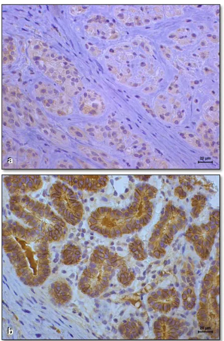 Figura 3. Imunoexpressão de HER-2 em carcinomas mamários de  cadelas.  a)  ausência  de  marcação  nas  células  neoplásicas  (resultado  negativo);  b)  marcação  positiva  3+  (acentuadamente  positiva;  marcação  completa  de  membrana;  reação  positiv