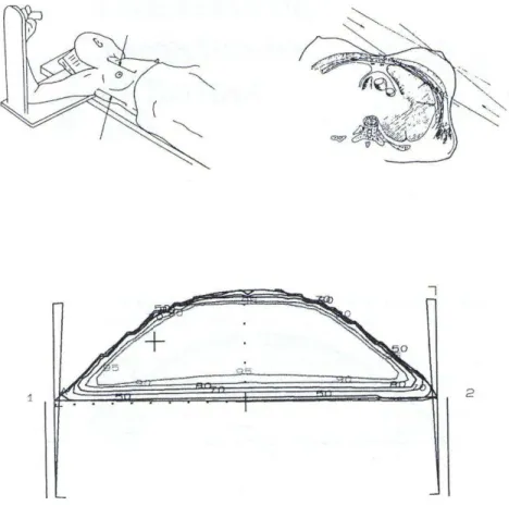 Figura 2.10  – Esquema tratamento teleterápico de mama.  Fonte: Adaptado de SCAFF, 1997