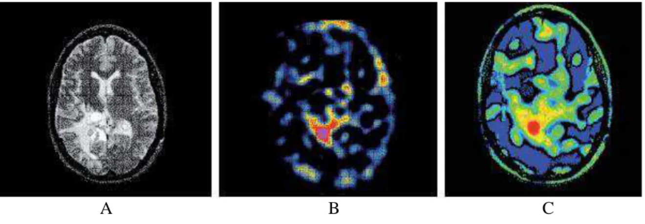 Figura 2.22 - Ilustração de imagens tomográficas: (A) anatômicas, (B) funcionais utilizadas para  determinação da distribuição de dose e (C) por método de Monte Carlo