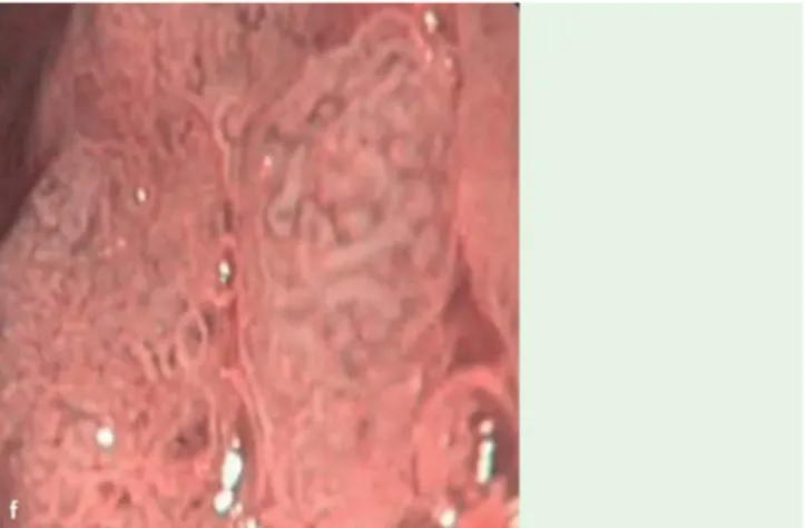 Fig. 2 The simplified classification of gastric lesions using narrow band imaging. a Pattern Aa –regular circular/oval mucosa surrounding regular thick vessels in the center of the gland; histology showed normal antrum mucosa; b Pattern Aa + –variable vasc