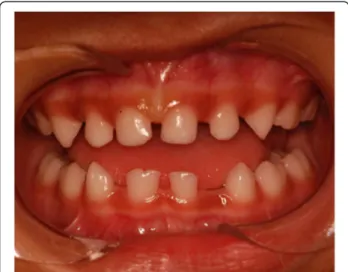Figure 2 Intraoral view of the mandibular primary double right central incisor and congenitally absence of both right and left lateral primary incisors.