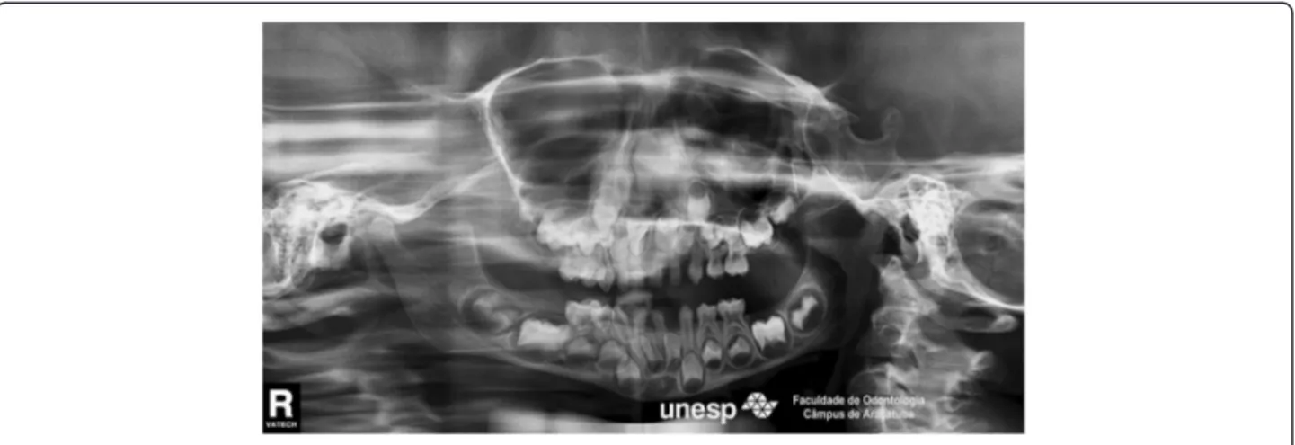 Figure 4 Orthopantomograph showing absence of a mandibular permanent incisor.