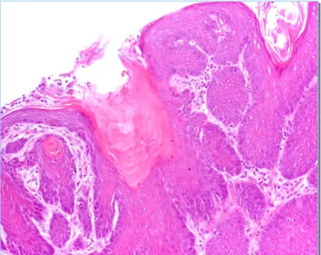 Figura 2.14-Metaplasia epidermóide (H&amp;E, 200X). 