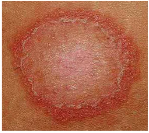 Figura 10: Lesão característica de          Figura 11: Lesão de tinea corporis e abaixo do                  tinea corporis (Retirado de:                   joelho um folículo piloso que foi acometido                                PRIMARY CARE DERMATOLOGY  