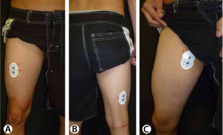 Figure 2. Positioning of the electrodes of the rectus femoris (A), biceps femoris (B)  and hip adductors (C) muscles.