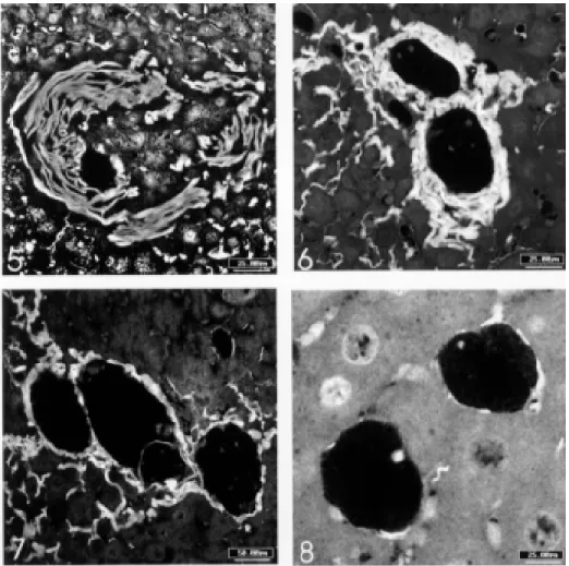 Fig. 5: involutional granuloma with dissociation and disintegration of the collagen fibers, mainly in the right side of the picture (phosphomolibdic acid-picrosirius, confocal laser scanning microscopy, bar = 25  m m)