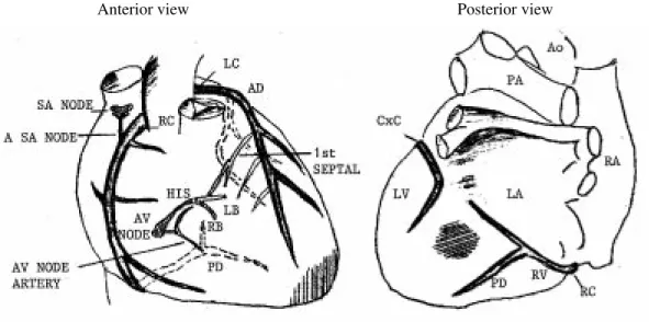 Fig. 1: schematic representation of ischemic lesions in chagasic hearts.