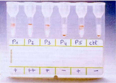 Fig. 2:  interpretation of the ID-particle gel immunoassay Chagas’ antibody test. P1, P2, P3 and P5: positive results