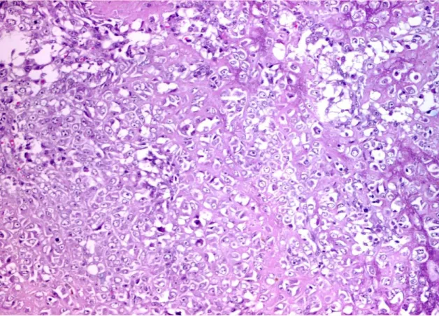 Figura  6:  Osteossarcoma  mamário  canino,  caracterizado  pela  proliferação  de  células  fusiformes  a  poliédricas, de elevada atipia citonuclear, associadas à produção de matriz osteóide (HE, Obj