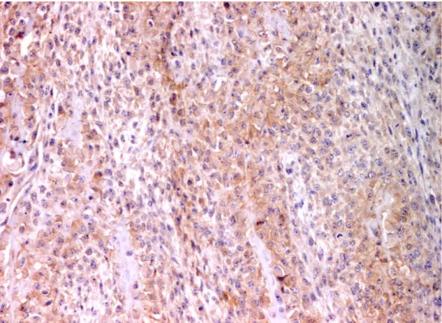Figura  13:  Osteossarcoma  mamário  canino.  Observam-se  células  neoplásicas  com  imunomarcação  citoplasmática e membranar para a β-catenina (β-catenina; Obj